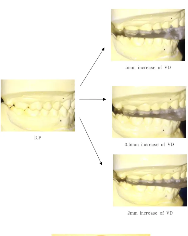 Fig. 3. Maxillary clear acrylic resin splint