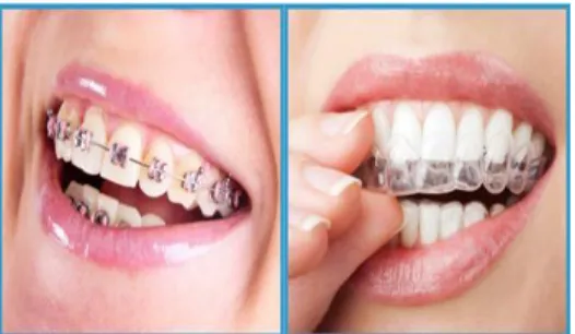 Fig.  1.  Bracket  and  clear  aligner