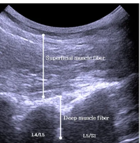 Fig  1.  Ultrasound  image  of  mulitifidus