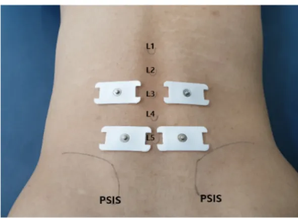 Fig 3. SEMG Sensor placement ( Multifidus,  Erector spinae) 지름 1  ㎝,  극간 간격이 2  ㎝인 전도용 겔이 부착되어 있는 은/염화은(Ag/Agcl)  전극을 사용한다