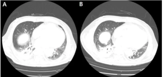 Fig. 2. Chest CT scan before and after Hyulbuchuko -tang treatment.