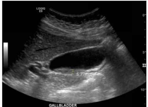 Fig 1. The Ultrasonographic image of the gallbladder. Ⅲ. 방법 및 결과 1. 한약치료 2020년 11월 9일부터 △△대학교 한방병원 한방 약무팀에서 조제한 생간탕(生肝湯) 엑스산제(Table 1) 6 g을 하루 2회 식후 30분 복용하였고, 2020년 12월 29일까지 경과 관찰하였다