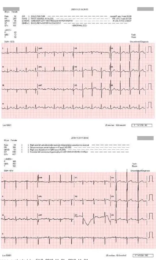 Fig. 1. Outcome evaluated by EKG 2019-11-21, 2019-11-24.
