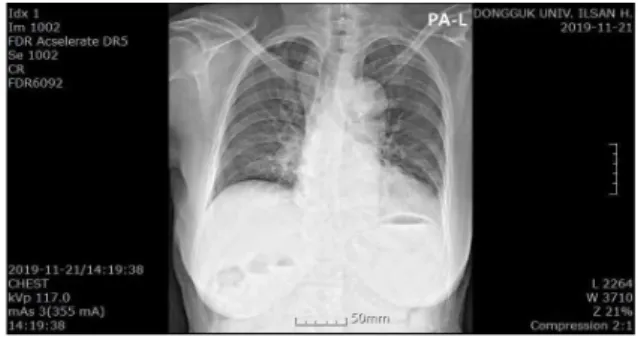 Fig. 2. Chest X-ray (PA) 2019-11-21. 11. 계통적 문진(Review of system) 1) 수 면 : 하루 5~6시간, 천면 2) 식사 및 소화 : 식욕부진 및 복부불편감으로 인한 식사량 감소(하루 일반 상식 1/2그릇, 2회) 3) 대 변 : 1~2일 1회 미경변 4) 소 변 : 주간 1~2시간 간격으로 빈뇨 양상, 야간 6~7회 배뇨, 복압성 요실금 양상 관찰 5) 설 진 : 舌紅, 鏡面舌, 地圖舌 6) 맥 진 : 脈浮