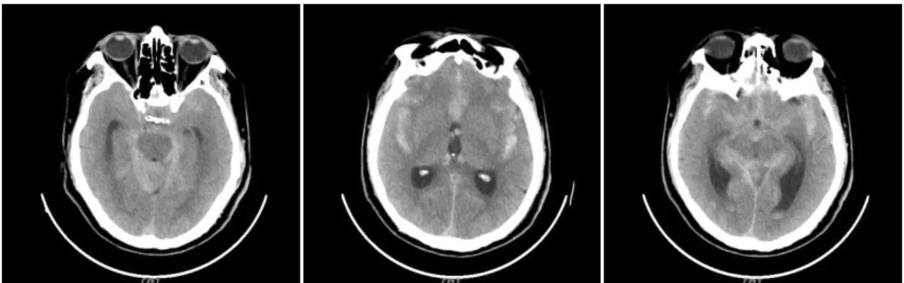 Fig. 3. Brain computed tomography (2020-09-16).