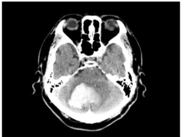 Fig. 1. Brain CT (2018-02-02).