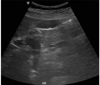 Fig. 1. Upper abdomen US (2020년 5월 7일).