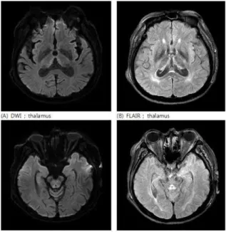Fig. 2. Brain MRI DWI &amp; FLAIR (2020.02.17.).