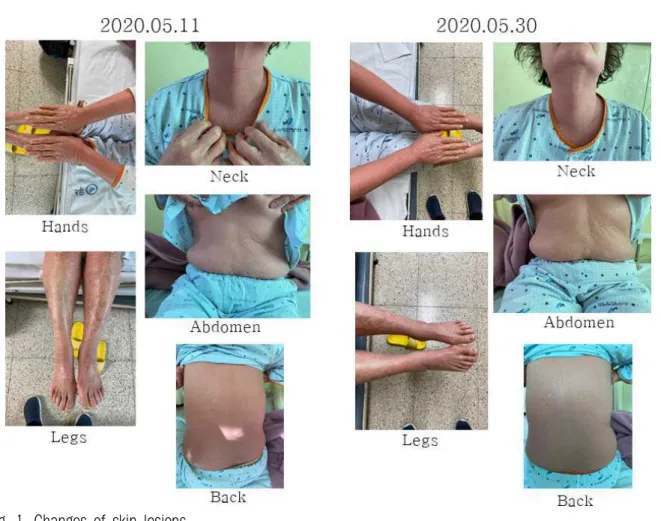 Fig. 1. Changes of skin lesions.
