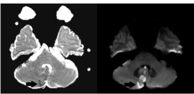 Fig. 1. Brain MRI ADC (left) and DWI (right) scan of magnetic resonance image (MRI).