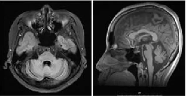 Fig. 2. Brain MRI, Cerebellar atrophy, otherwise unremarkable.