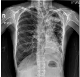 Fig. 1. Chest X-ray PA view. Ⅲ. 치료 및 경과 1. 치료 내용(Table 1, 2) 2018년 10월 15일부터 2018년 11월 7일까지 24일 간의 입원 기간 동안 한약 치료 및 22회의 침 치료, 1회의 전침 치료, 3회의 약침치료, 4회의 뜸 치료를 시행하였다