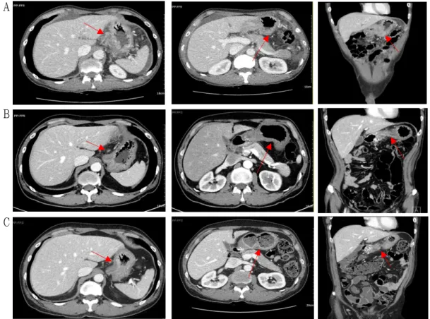 Fig. 1. Comparison of computed tomography (CT) images before and after treatment.