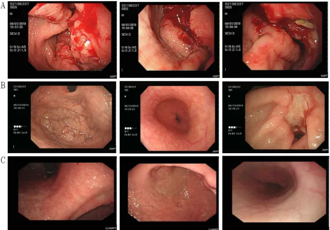 Fig. 2. Comparison of esophagogastroduodenoscopy (EGD) images before and after treatment.