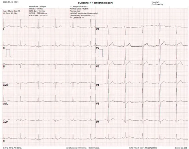 Fig. 1. EKG in admission.