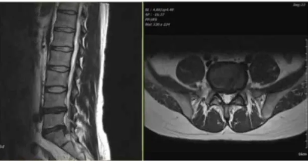Fig. 2. T2 weighted sagittal and axial view of L5/S1 (2018.07.16) 2) 임상병리검사 : 신기능을 평가하기 위하여 가장자주 사용되는 임상화학검사는 BUN, 혈청 Creatinine수치이다11