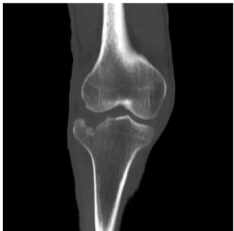 Fig. 3. Rt. tibia &amp; femur X-ray.