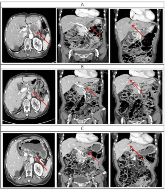 Fig. 1. Comparison of computed tomography (CT) images before and after treatment.
