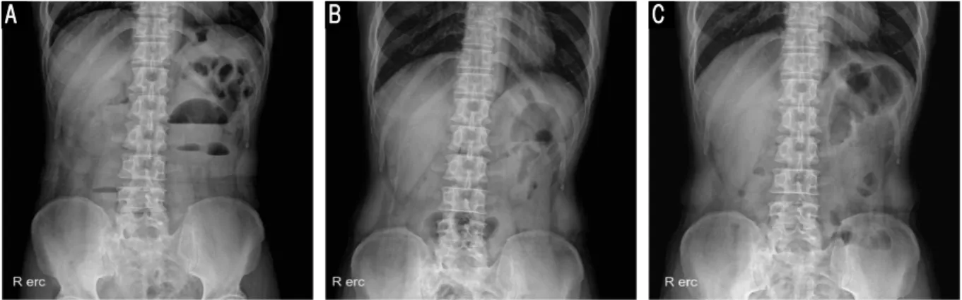 Fig. 2. Comparison of abdomen erect X-ray findings in hospitalization period.