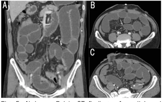 Fig. 5. Abdomen-Pelvis CT findings of small bowel obstruction on October 23th, 2019.