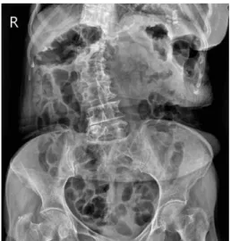 Fig. 2. 20.01.20 X-ray abdomen erect, supine.