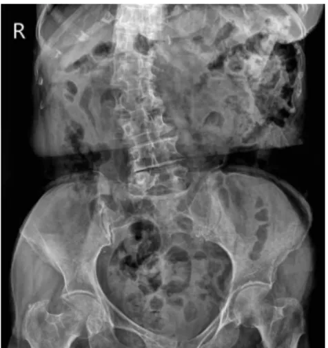 Fig. 3. 20.01.27 X-ray abdomen erect, supine. 7) 2020년 01월 29일 : 5일만에 손가락 굵기 정도 의 loose stool을 4회 배변하였다