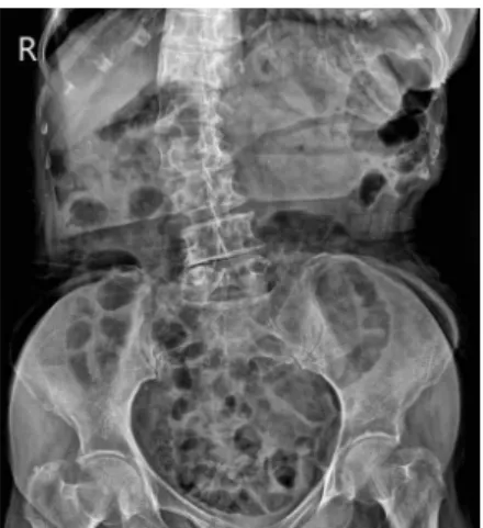 Fig. 6. 20.02.26 X-ray abdomen erect, supine. 13) 2020년 03월 11일 : 내원 며칠 전부터 매일 자의 배변이 가능하고, 식사량도 유지되었다