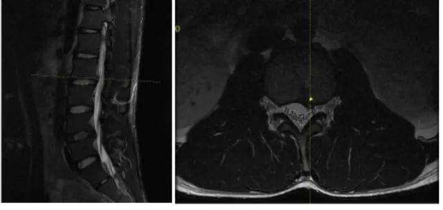 Fig. 1. L-SPINE MRI T2 (2018.12.26.) L2/3.