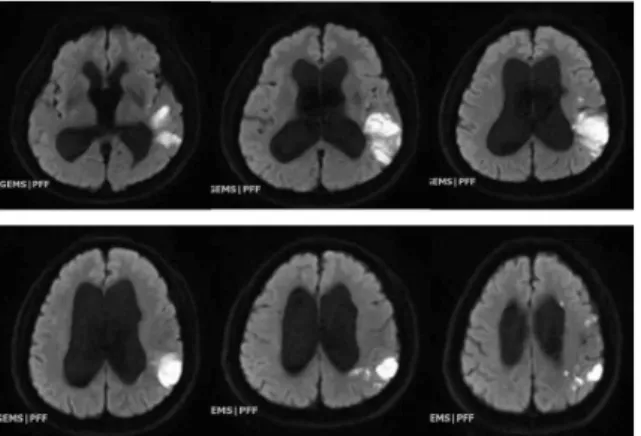 Fig. 1. Brain MRI DWI (2018.09.18.).