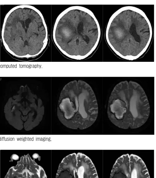 Fig. 1. Brain computed tomography.