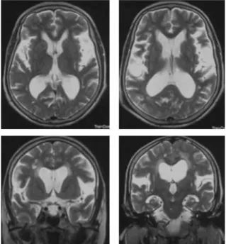 Fig. 1. Brain MRI 2007-11-27.