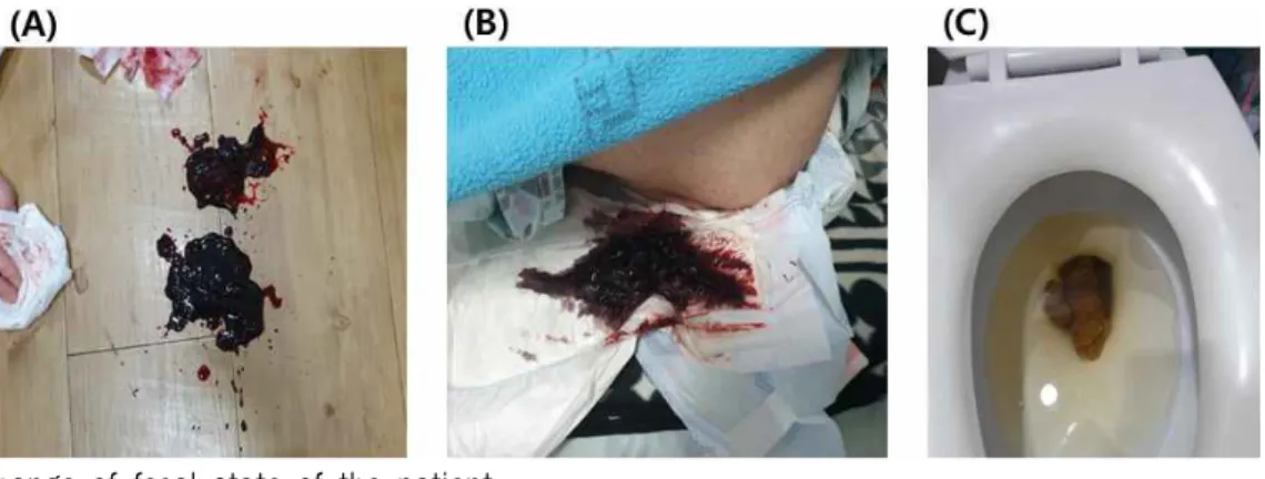 Fig. 3. Change of fecal state of the patient.