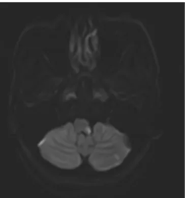 Fig. 3. Changes of the number of dermatomes affected by right extremity sensory loss (contralateral)