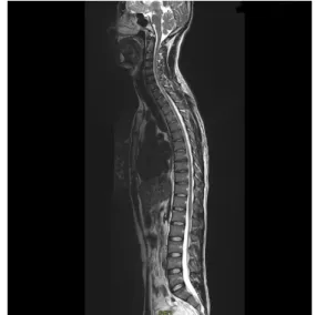 Fig. 2. Hip MRI (T1).