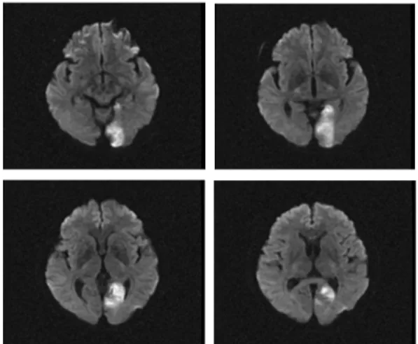 Fig. 1. Patient’s brain MRI (DWI) images.