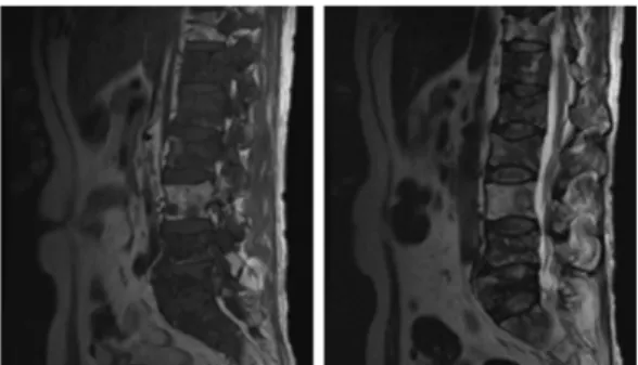 Fig. 1. L-SPINE MRI with CTL (2019.03.08.).