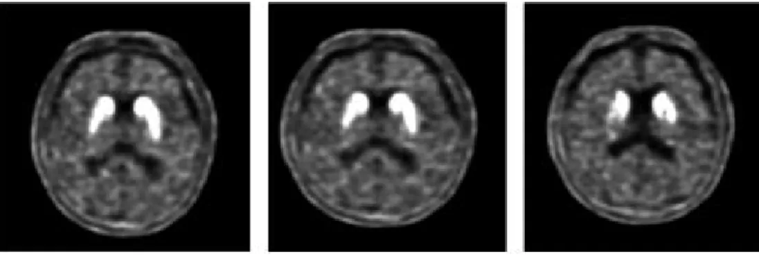 Fig. 1. FP-CIT PET.