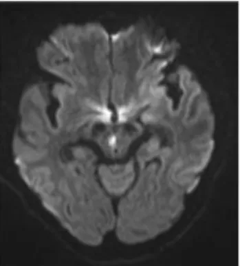 Fig. 1. Diffusion weighted Imaging findings of the brain (X.5.22.) high signal intensity lesion on DWI at right paramedian midbrain.