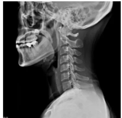 Fig. 4. C-SPINE x-ray of case 2.