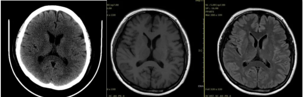 Fig. 5. Brain CT, MRI (T1), MRI (T2) of case 3.
