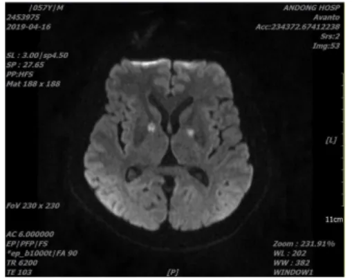 Fig. 1. Brain MRI DWI of the date of the CO intoxication. 9. 이학적 검사 2019년 05월 13일 본원 입원 당시 Mental state, T/P/P -/-/+- 하였으며 MMSE-K 0점, Activity Index score 58점이었으며 스스로 기립위 유지 가능 및 200 m 가량 보행 가능 하였으나 계단 보행은 불가하였다