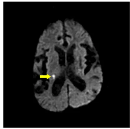 Fig. 1. Brain MRI T2 (2019.04.23).