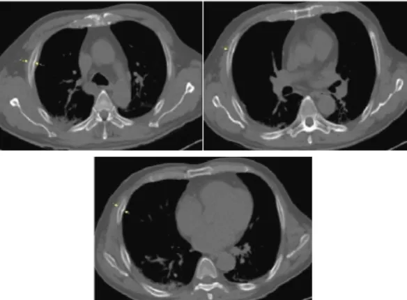Fig. 1. Patient 1-fractures of right 3rd, 4th, 5th rib.