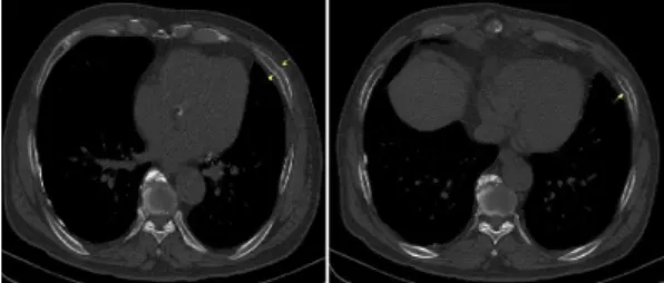 Fig. 2. Patient 2-fractures of left 6, 7th rib.