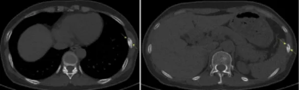 Fig. 4. Patient 5-fractures of left 7, 9th rib.
