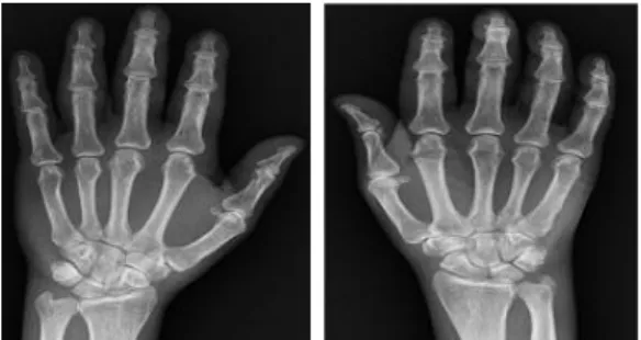 Fig. 1. Both hand x-ray.