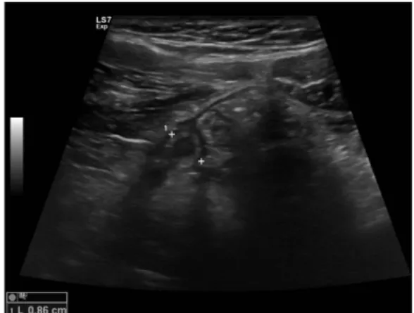 Fig. 1. Transverse section in appendicitis by ultrasonographic test.