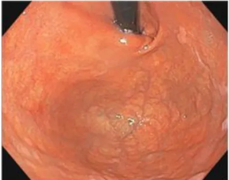 Fig. 2. Esophagogastroduodenoscopy (X-1.6.18.).