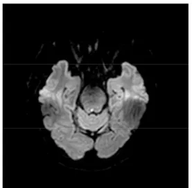 Fig. 2. Brain magnetic resonance imaging (diffusion -weighted image, transverse view).