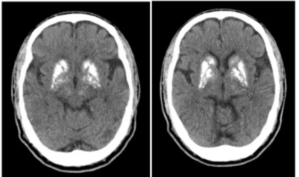 Fig. 1. Brain CT image of patient.